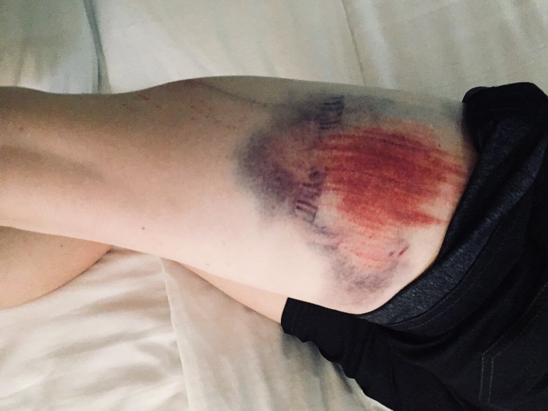 KRistine contento-angell leg bruise at bonelli